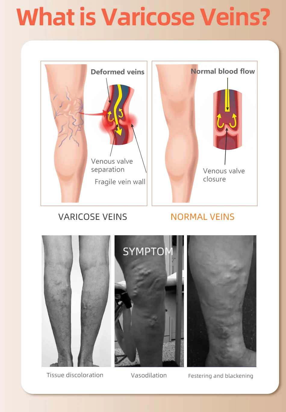 30-40 MmHg Over Knee Closed To - Compression Sock Medical ulasan dan harga